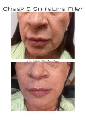 cheek filler