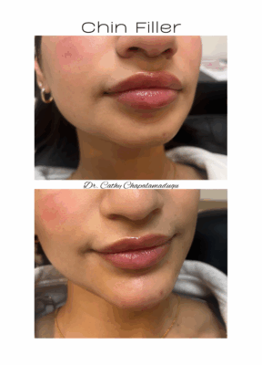 chin filler 1