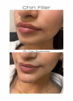chin filler 2