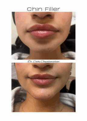 chin filler 3