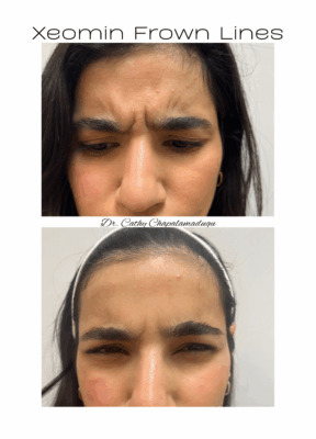 frown lines