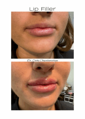 lip filler 2