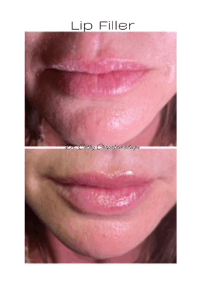 lip filler