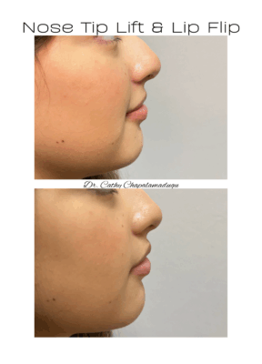 nose tip